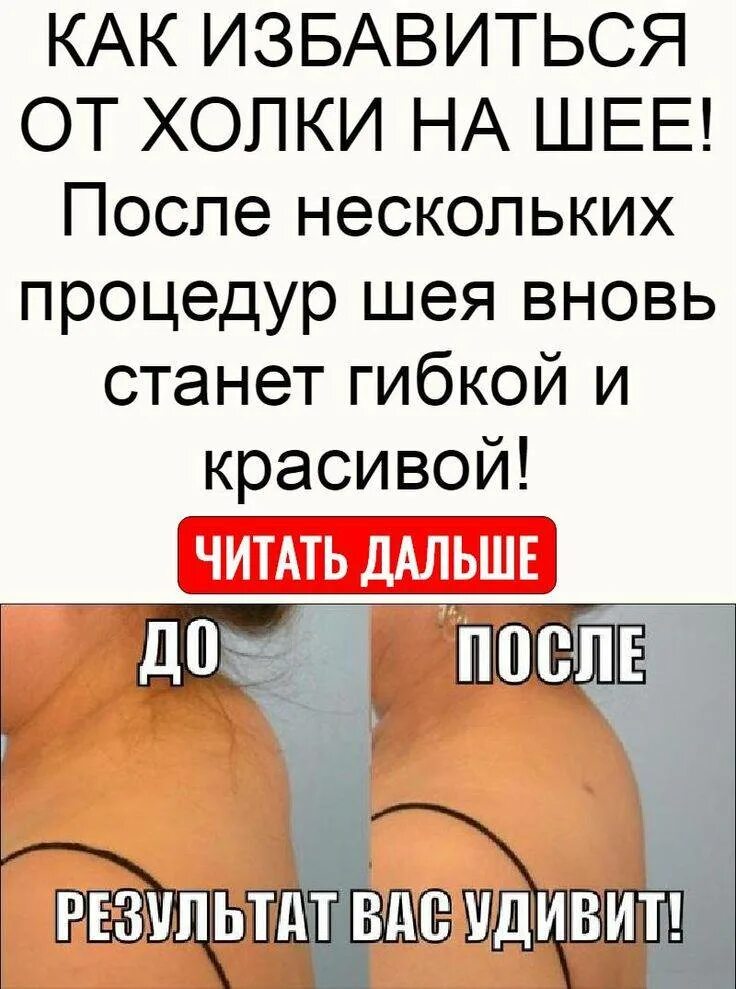 Эффективные упражнения от холки на шее. Лазерный липолиз вдовий горб. Упражнения чтобы убрать холку. Избавление от холки на шее. Средство от холки.