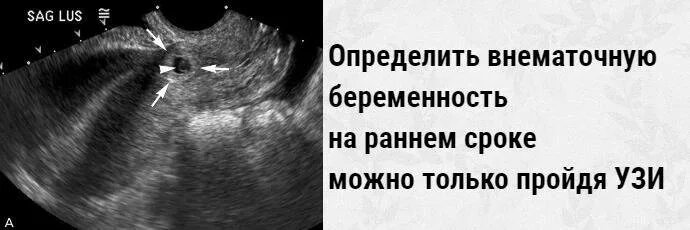 Ошибаются ли узи со сроком. Внематочная беременность на узи. эктопическая беременность узи. внематочная беременность по узи. узи внематочной беременности на раннем сроке.