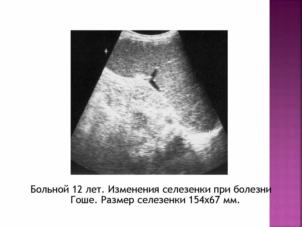 Болезнь Гоше селезенка УЗИ. Селезенка при болезни Гоше. Спленомегалия болезнь Гоше. Цена селезенки