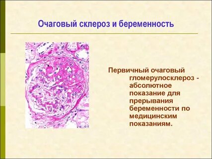 Склероз нижних