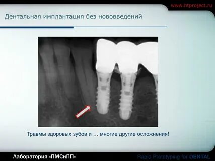 Имплантация проблемы