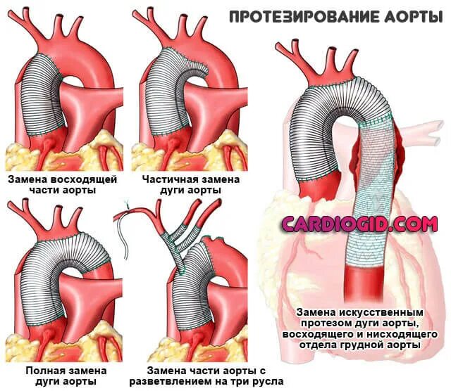 Аневризма аорты восходящего отдела сердца операция. Расслаивающая аневризма аорты хирургия. Расслаивающаяся аневризма дуги аорты. Операции при расслаивающей аневризме аорты. Аневризма показания к операции