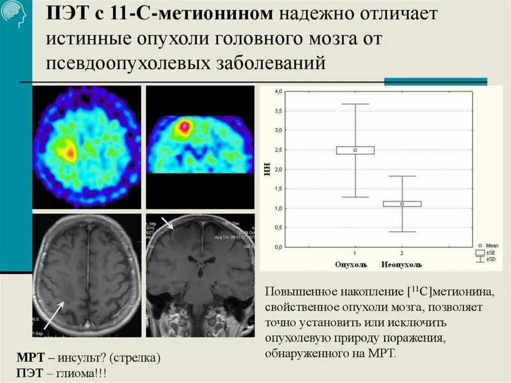 ПЭТ кт головного мозга. ПЭТ кт опухоли головного мозга. Позитронно-эмиссионная томограмма головного мозга. Позитронно-эмиссионная томография опухоли. Пэт с тирозином