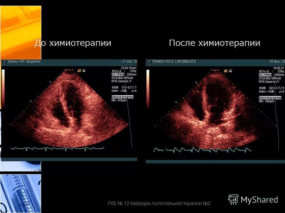 Яичники после химиотерапии