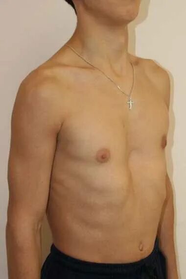 Воронкообразная деформация грудной клетки. Воронкообразная деформация грудной клетки у ребенка 2 года. Выпирает грудная клетка. Выпирают ребра у мужчины. Выпирает ребро с левой стороны.