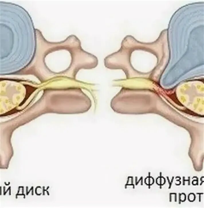 Дорзальная протрузия. Дорзальная протрузия диска что это такое. Диффузное дорзальное выпячивание диска l5-s1. Дорзальные протрузии с3-4. Диффузная протрузия межпозвонковых