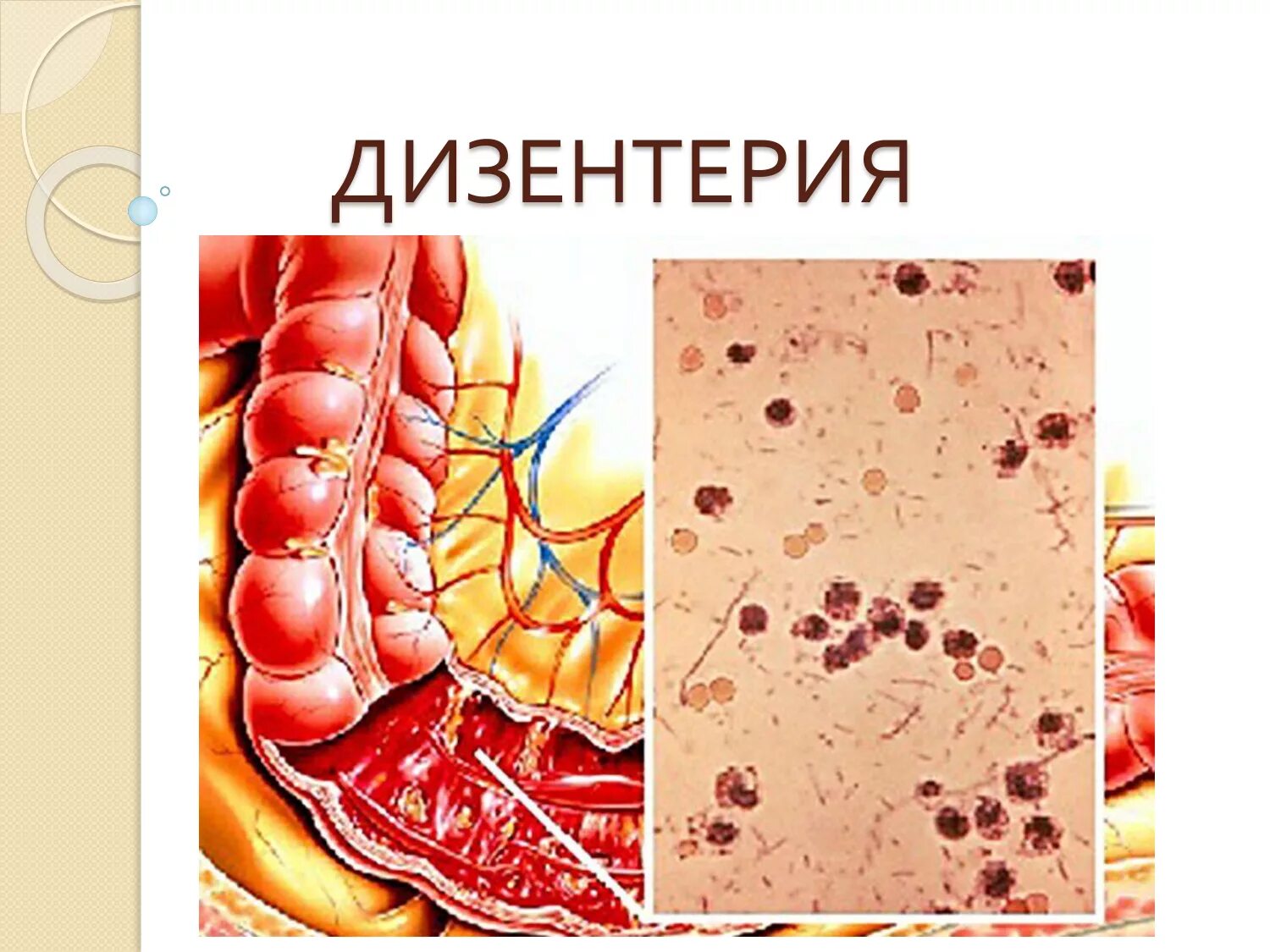 Дизентерия проявления. Дизентерия. дизентерия клиническая картина.