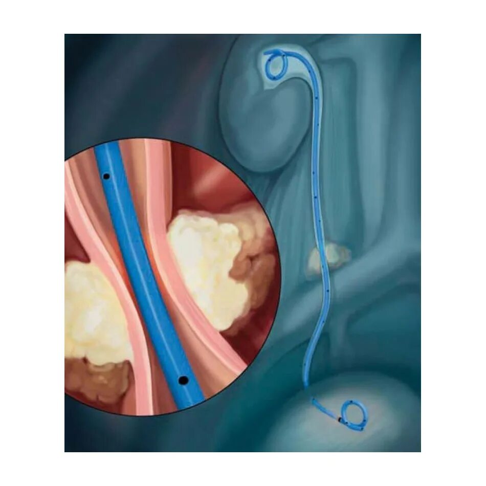 Катетеризация мочеточника. Катетер стент мочеточника. Стент мочевыводящих путей. Стентирование почки при камнях в мочеточнике.