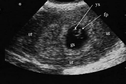 Внематочная беременность 6 недель УЗИ. Внематочная беременность 5-6 недель УЗИ. 4 5 Недель беременности УЗИ внематочная. УЗИ внематочной беременности 5 недель. Внематочная 5 недель