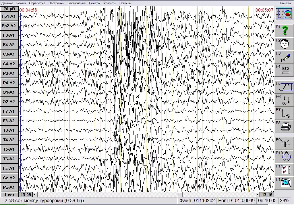 Ээг кемерово. Снимки ЭЭГ при эпилепсии. Спектрограмма ЭЭГ. ЭЭГ схема. ЭЭГ В абсанс.