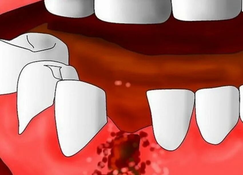 Остановить кровотечение удаления зуба. Постэкстракционный альвеолит. Альвеолит альвеолит лунки зуба.