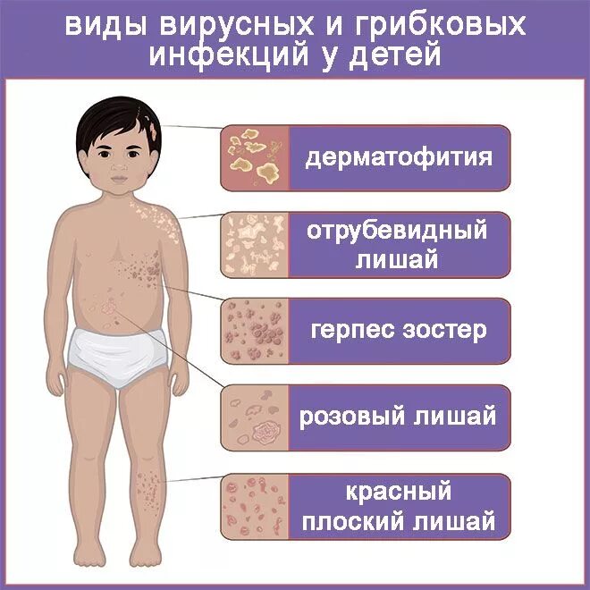 Картинки ОСПА ИНКУБАЦИОННЫЙ ПЕРИОД И КАРАНТИН
