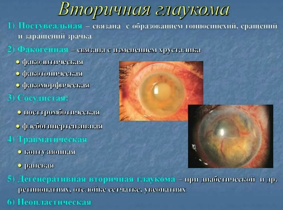 Вывих хрусталика