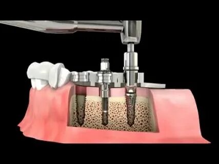 Neobiotech импланты отзывы