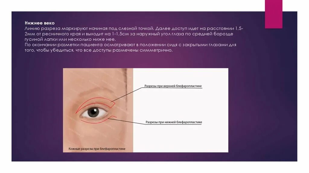 Анатомия века блефаропластика. Клиническая анатомия век. Ресничные края век анатомия.