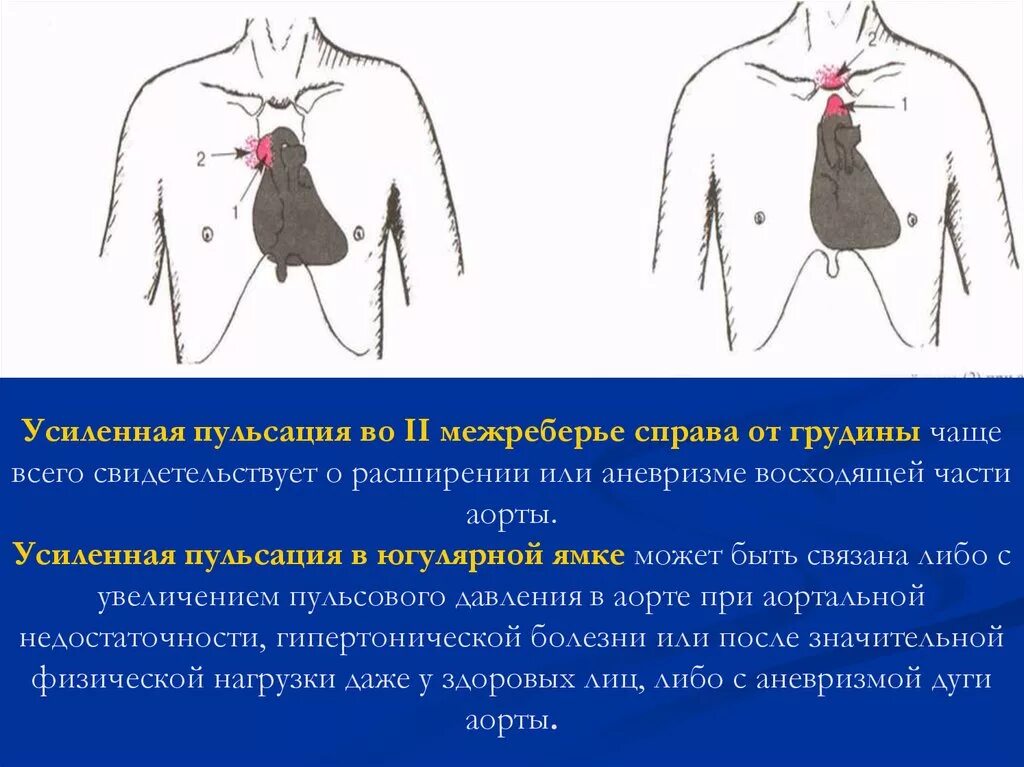 Пульсация в грудной клетке справа. Пульсирует в грудной клетке справа. Пульсация во втором межреберье справа. Пульсация аорты справа от грудины.