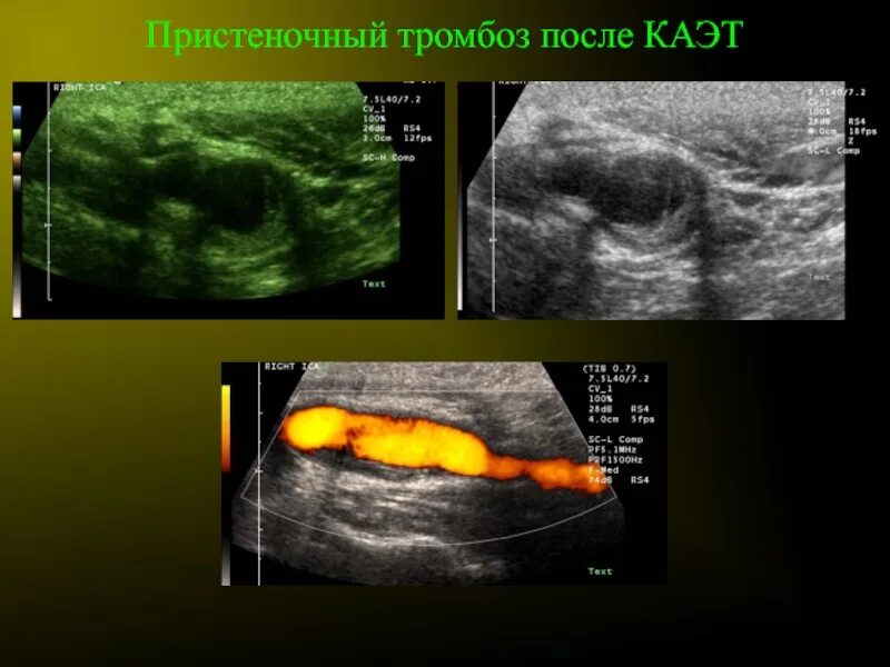 Пристеночный тромб ПДВ. Киста с пристеночным компонентом. Пристеночный тромбоз нарушения. Пристеночный тромбоз