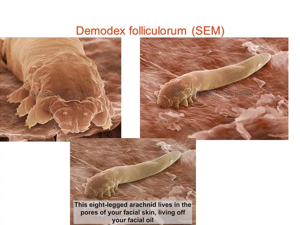 Железница угревая Demodex folliculorum. Клещ демодекс жизненный цикл