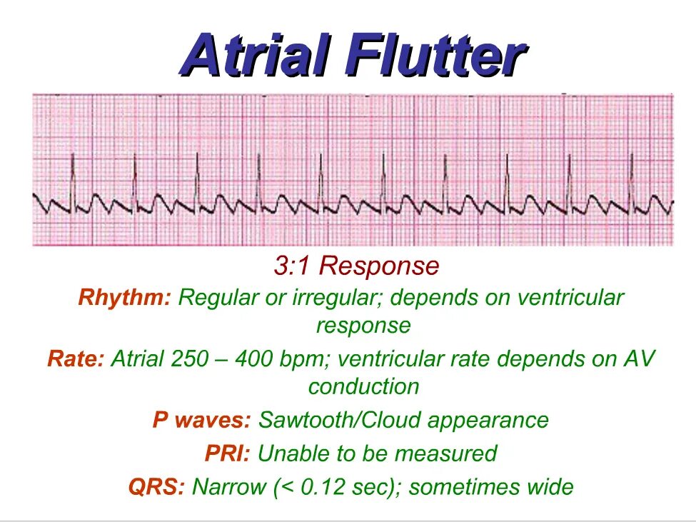 Flatter means. Atrial Flutter ECG. Atrial Fibrillation ECG Criteria. Ventricular Flutter ECG. Atrial tachycardia ECG.