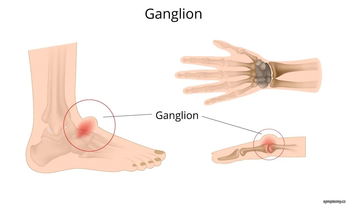 Ганглий лучезапястного сустава. Гигрома лучезапястного сустава. Сухожильный ганглий 1 пальца кисти. Гигрома сухожильный ганглий.