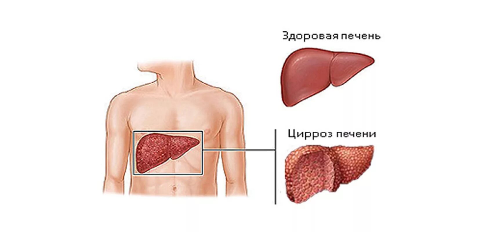 Заболевания печен. Цирроз печени картинки.