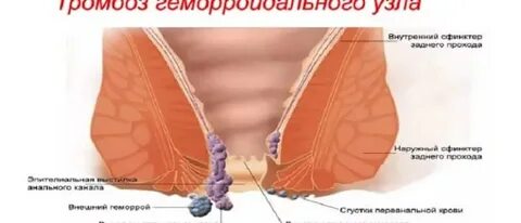 Геморрой узлы наружные и внутренние