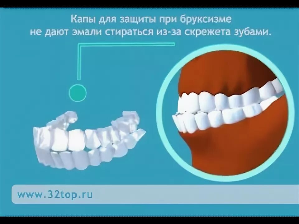 Трансляции капы. Капа для отбеливания зубов (на 2 челюсти). Капа защита для зубов. Капы для прикуса зубов. Капа для зубов при бруксизме.