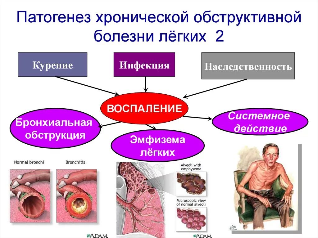 Хронические заболевания отсутствуют. Хроническая обструктивная болезнь легких. ХОБЛ проявляется признаками. Лгхроническая обструктивная болезнь лёгких. Болезни лёгких у человека ХОБЛ симптомы.