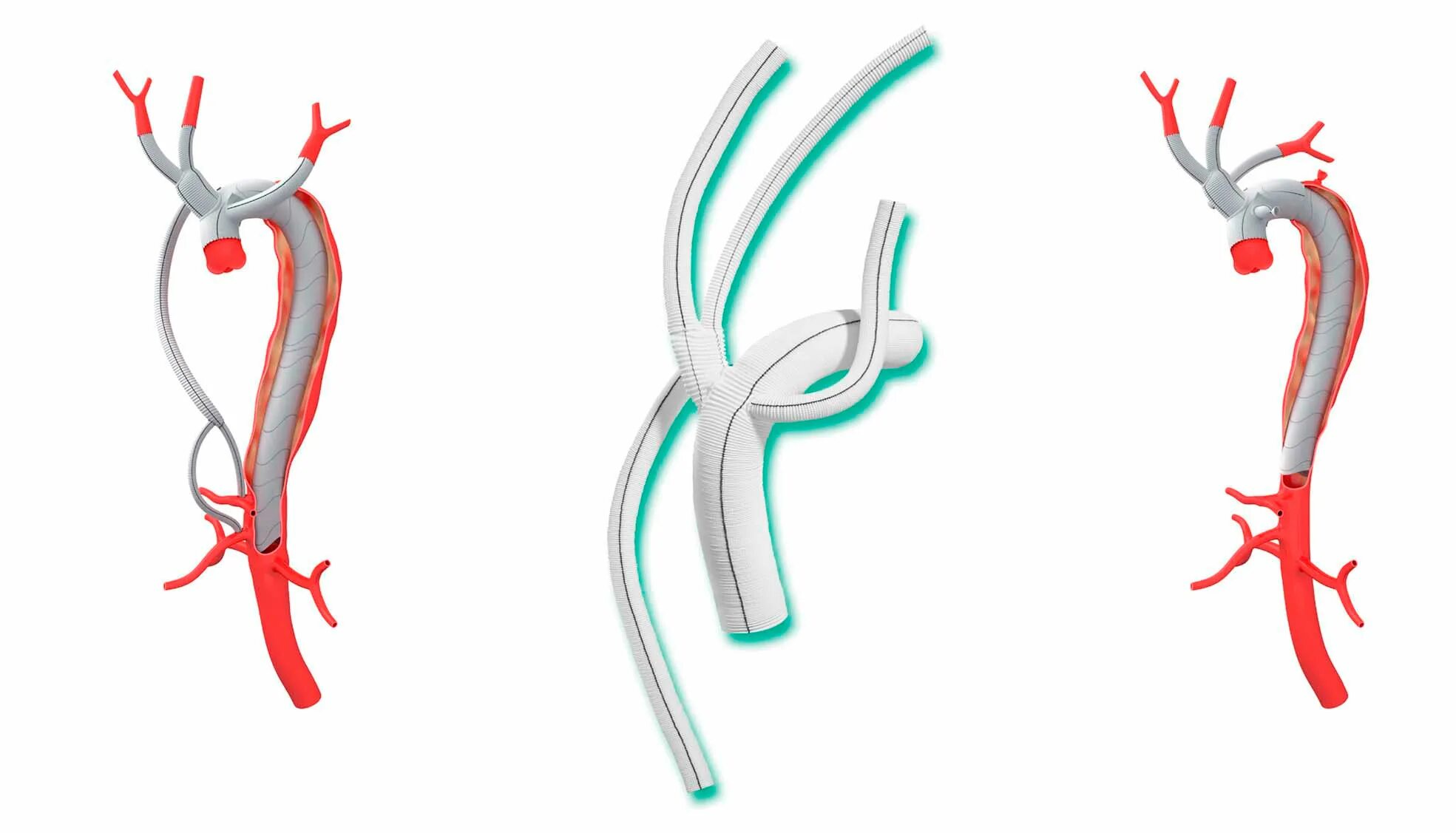 стент графт брюшной аорты. аневризма бифуркации отдел аорты. протезирование аневризмы. стент графт аорты операция. диссекция грудной аорты.