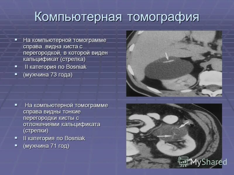 Классификация кт. Кисты по босниак кт. классификация кист почек по bosniak кт. кисты по босняку на кт.