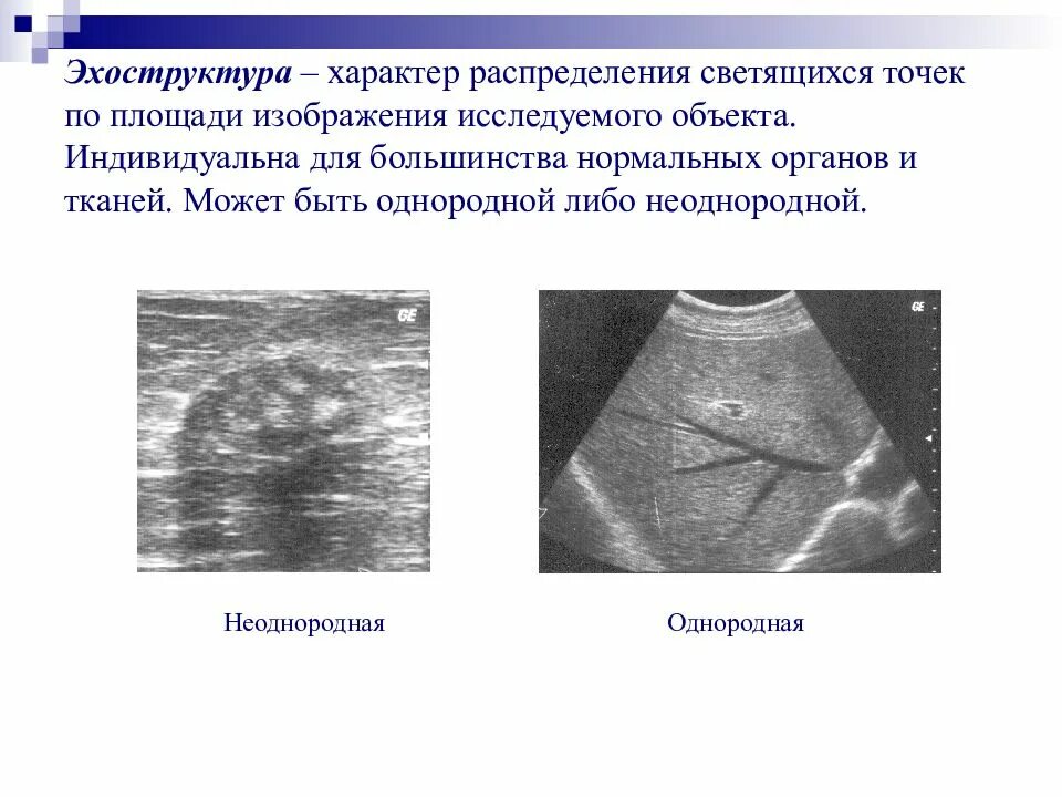 Повышенной эхогенности неоднородной структуры