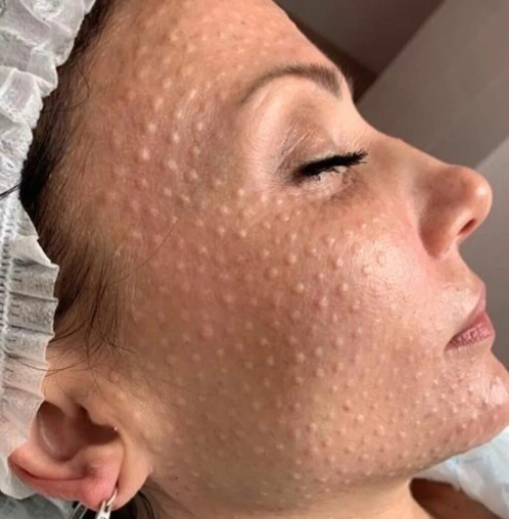 Биоармирование. Биоревитализация папулы. Биоревитализация лица рекомендация. Мезотерапия гиалуроновая кислота. Плюсы и минусы биоревитализации отзывы.