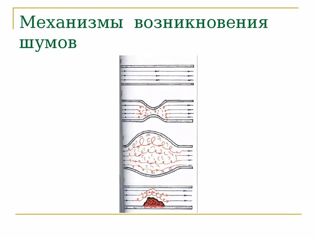 Причины появления шумов. Механизм образования шумов сердца. Механизм формирования шумов сердца. Шумы сердца механизм возникновения классификация. Механизм возникновения систолического шума.