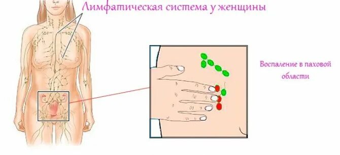 Лечение лимфоузлов в паху у женщин. Паховые лимфоузлы у женщин расположение. расположение лимфоузлов в паху у женщин схема. паховые лимфоузлы расположение. лимфатические узлы в области паха у женщин.