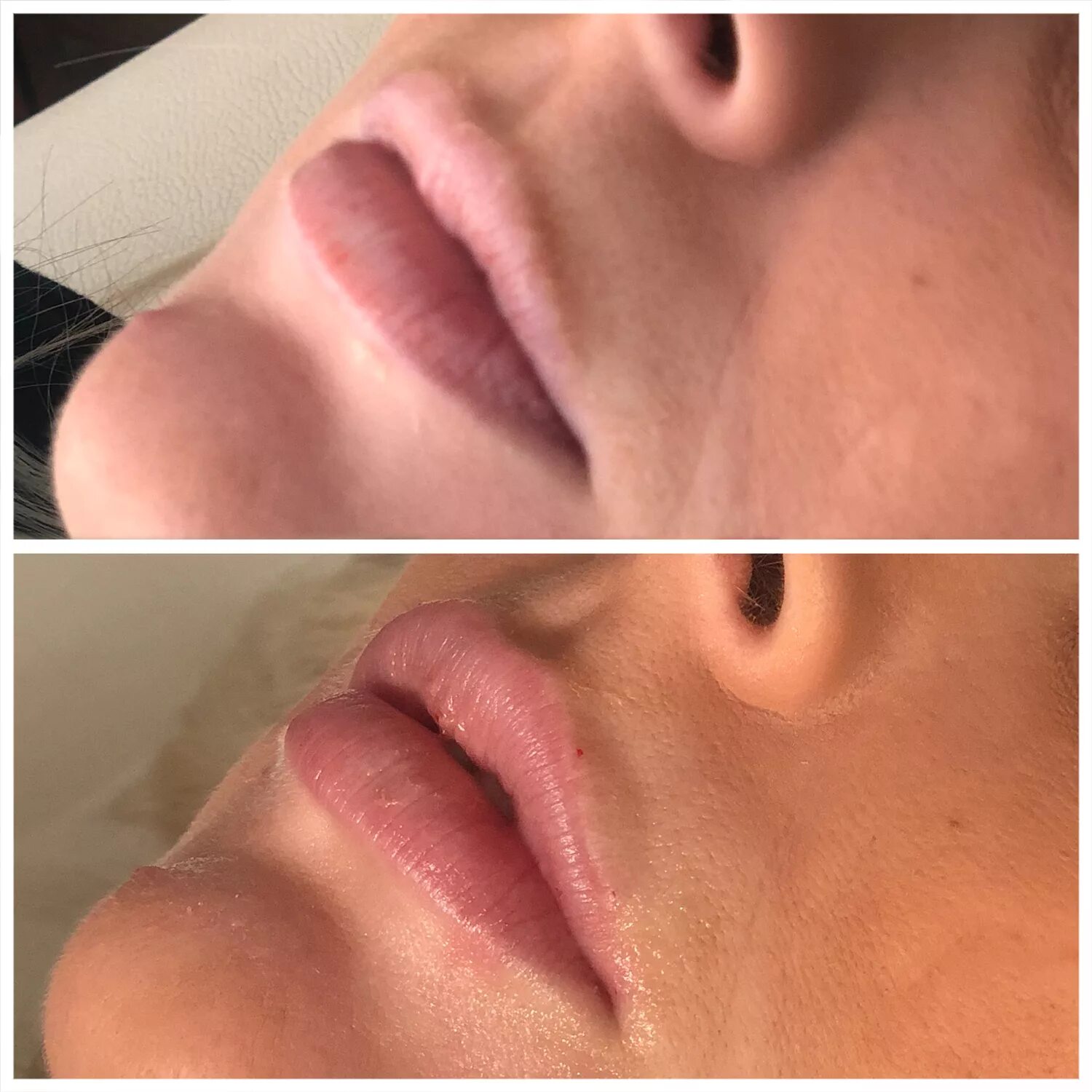 Juvederm Ultra 3. Ювидерм и стеллаж.