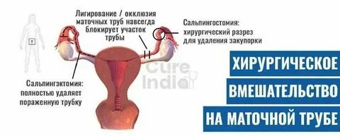 Завязали трубы можно забеременеть