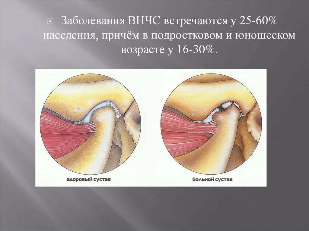 Лечение челюстного артрита. Мышечно суставная дисфункция ВНЧС. Дисфункция ВНЧС симптомы. Посттравматическая дисфункция ВНЧС.