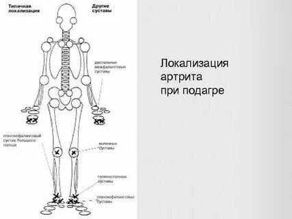 При подагре поражаются суставы