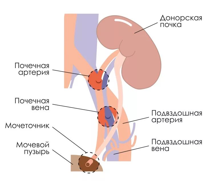 Донор почки сколько. Трансплантация почки методика. Ортотопическая трансплантация почки. Трансплантация почки схема.