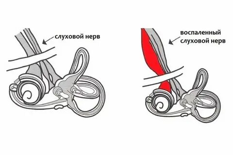 Неврит слухового нерва