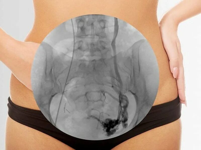 Опухоли яичников гинекология. Улучшаем кровообращение. Застой в малом тазу симптомы. Варикозное расширение вен параметрия малого таза. Суставы малого таза.