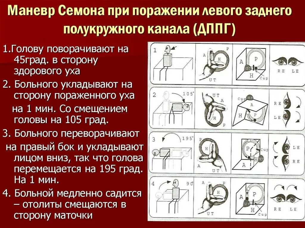Головокружение в вертикальном положении. Маневры семонта эпли. упражнения при позиционном головокружении. упражнения при доброкачественном позиционном головокружении. позиционное головокружение.