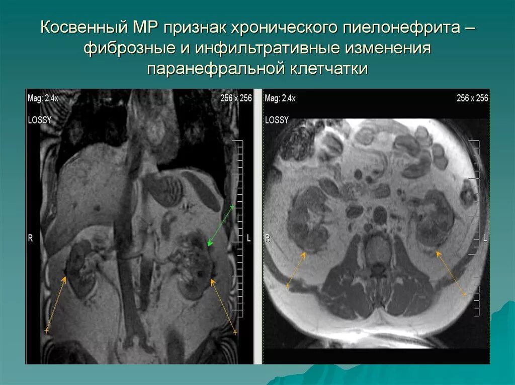Внутричерепная гипертензия на кт. Косвенные кт признаки. Тромбоэмболия легочной артерии на кт. Инсульт мрт диагностика. Косвенные признаки бронхита на рентгене.