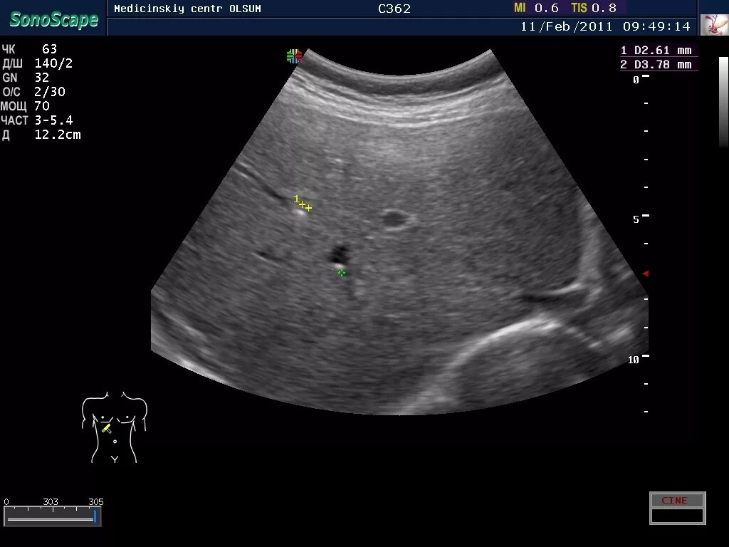 Камни в печеночных протоках на УЗИ. Конкременты в протоках печени УЗИ.