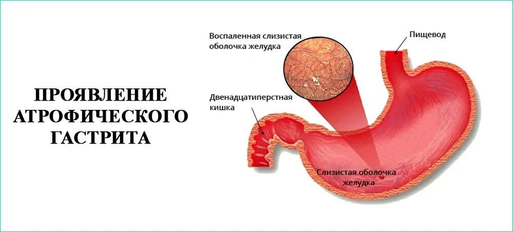 Поверхностный антральный гастрит. Атрофический гастрит патанатомия. Гастрит слизистой оболочки желудка воспаление. Атрофия слизистой антрального отдела желудка Тип с-1. Хронический гастрит воспаление