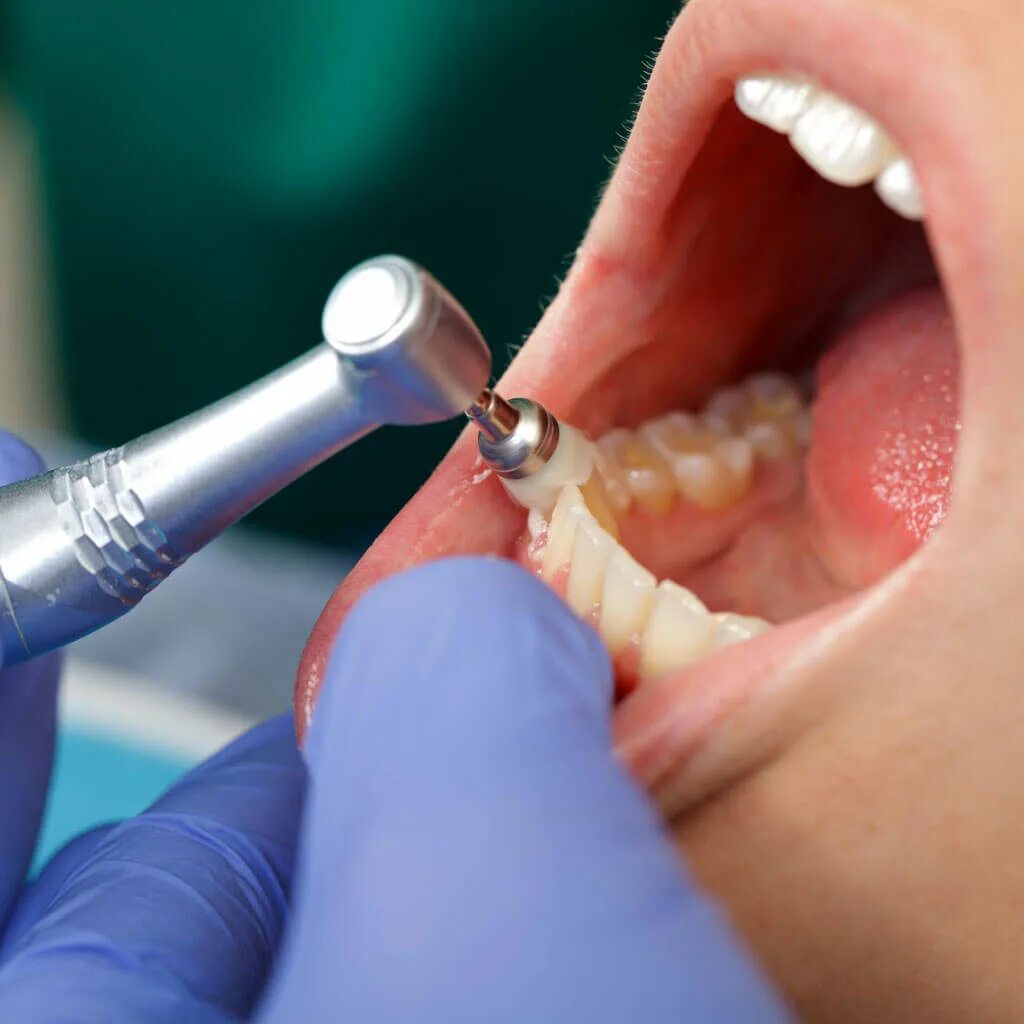 Комплексная гигиена рта. Профгигиена (ультразвук + Air-Flow). Профессиональная гигиена полости рта. Профессиональная гигиена полости рта в стоматологии.