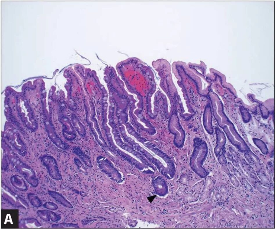 Метаплазия желудка отзывы. Пилорическая метаплазия. Метаплазия эпителия желудка. Тонкокишечная метаплазия гистология. Кишечная метаплазия желудка гистология.