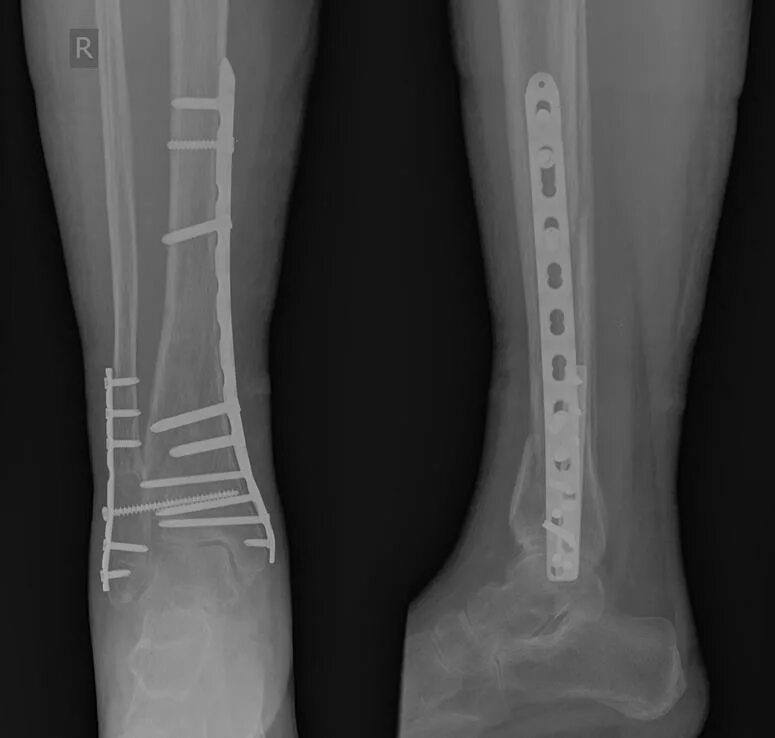 Перелом берцовой кости голени. Перелом большеберцовой кости. Перелом берцовой кости операция. Малая берцовая кость перелом.