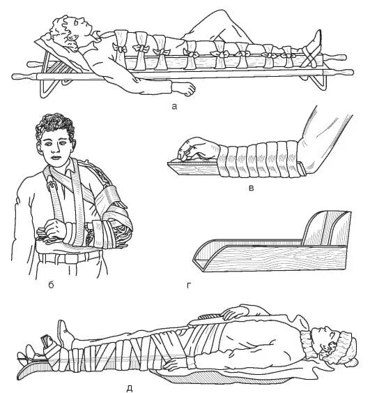 Д3 при переломах. Транспортная иммобилизация Крамера. Иммобилизация конечности транспортной шиной. Иммобилизация нижней конечности шиной Крамера. Иммобилизация пострадавшего при переломе нижних конечностей.
