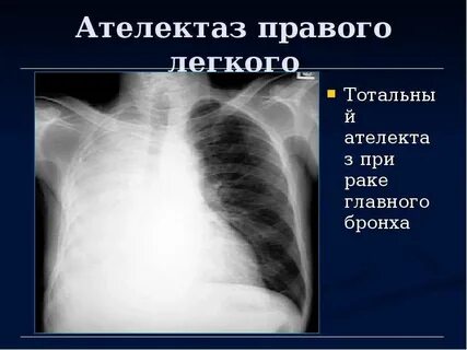 Сжатое легкое